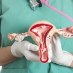 Día Mundial del Cáncer de Ovario: los 6 factores de riesgo